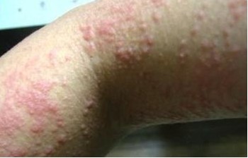 怎样治疗疥疮最好