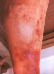 疥疮结节怎么治疗