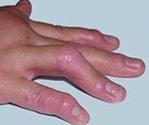 关节病型牛皮癣的保健方式