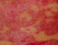 为什么会有红皮病型牛皮癣