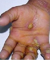 疥疮的治疗方法和注意事项