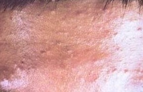 疥疮治疗为何容易反复发作