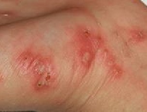 如何治疗疥疮结节