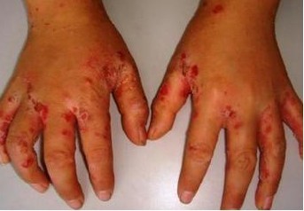 对疥疮如何治疗的方法