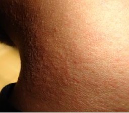 为什么会得疥疮