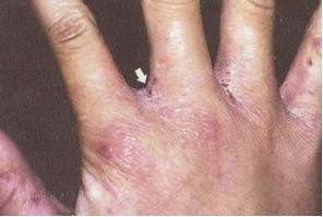 中医治疗疥疮的方法