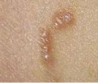 疥疮有什么症状