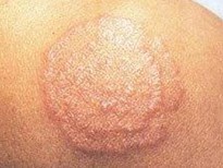 具体体癣的症状有哪些的呢