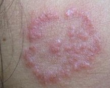 如何治疗体癣不复发