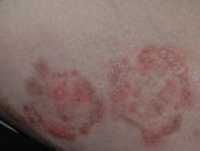 体癣给患者带来的危害