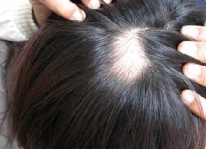 青少年脱发的原因