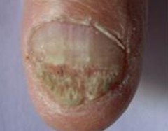 甲癣会给患者带来哪些影响