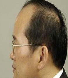 Ö¬ÒçÐÔÍÑ·¢Ö¢×´