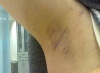 常见的狐臭的症状