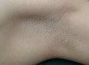 腋臭治疗最佳时间