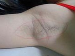 遗传性腋臭能根治吗