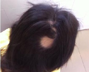 脂溢性脱发和斑秃的鉴别比较