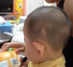 儿童出现斑秃怎么办