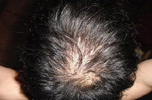 导致男性脱发的常见因素