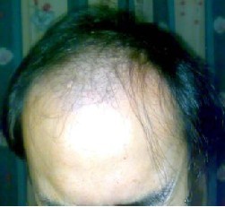 治疗斑秃注意的重点