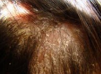 脂溢性脱发常见症状有哪些