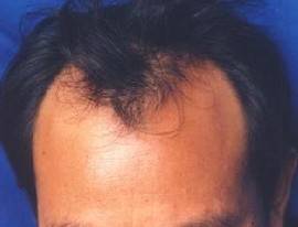 斑秃的症状分期