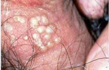 现代医学中生殖器疱疹的治疗方法