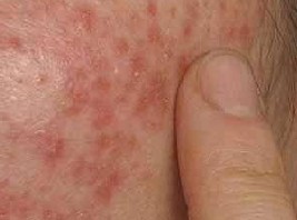 皮肤瘙痒抓后起小红疹怎么办