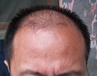 脱发好资料什么最有效