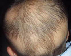 脱发斑秃治疗方法