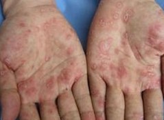 梅毒的发病原因有哪些