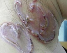 三期梅毒(晚期梅毒)的病因