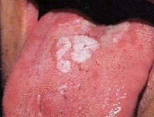 二期梅毒疹的临床症状有哪些