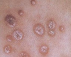 常见梅毒疹的类型有哪些