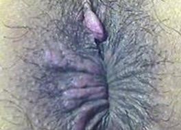 如何防止染上梅毒