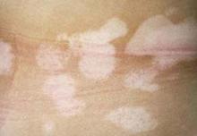 白癜风治疗最好方法