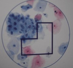 淋病发病原因是什么