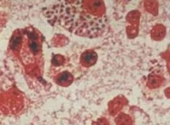 淋病反复发作的原因是什么