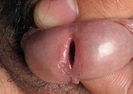 淋病是如何传染的