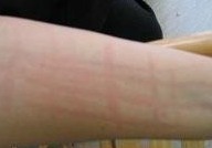 划痕性荨麻疹的治疗