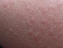 胆碱能性荨麻疹的危害