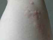 如何预防才能不让荨麻疹反复发作