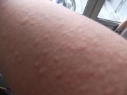 南昌医院荨麻疹哪种治疗方法最好