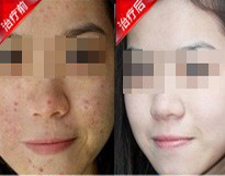 青春痘治疗康复案例