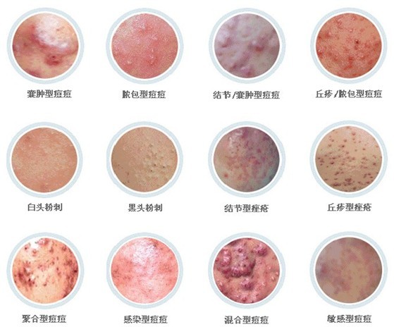 青春痘的症状