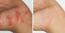 荨麻疹治疗前后对比