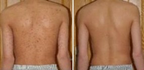 荨麻疹治疗前后对比