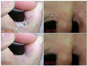 湿疹治疗康复对比