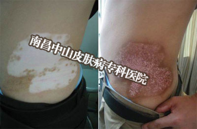 南昌中山皮肤病医院白癜风康复案例