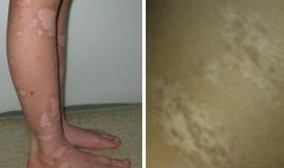 白癜风症状
